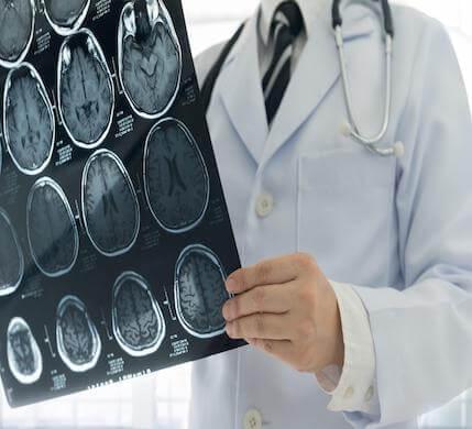 some-coronavirus-patients-may-suffer-micro-strokes-are-too-small-notice-dizziness-or-confusion-could-be-sign-1937945